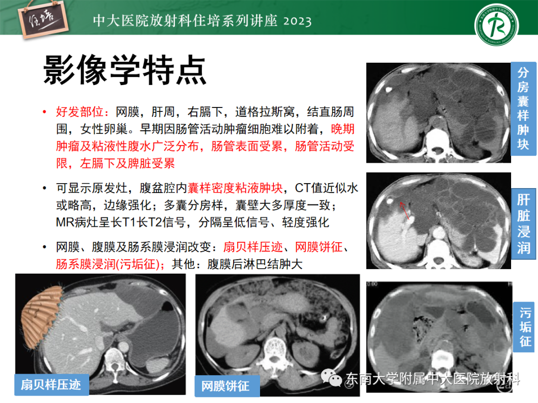 影像PPT - 【PPT】腹膜弥漫性病变-41