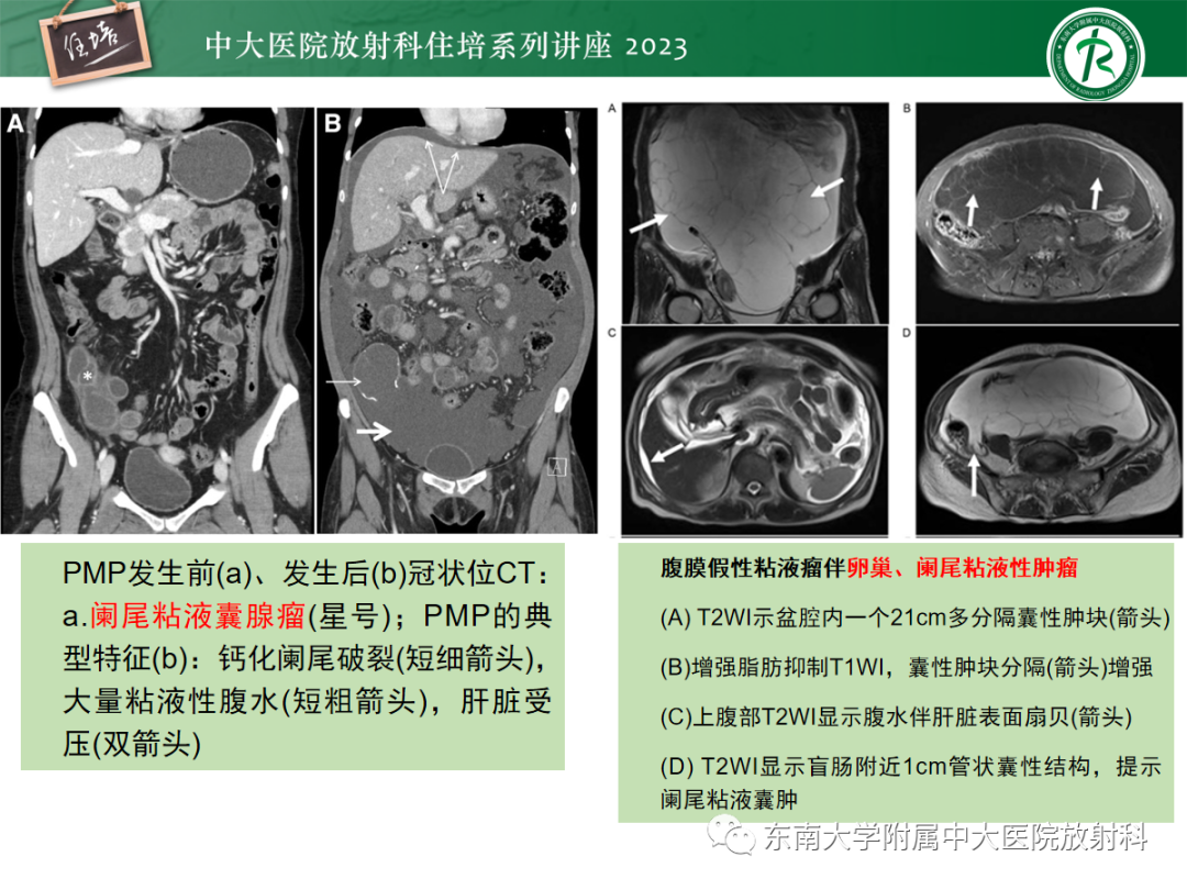 影像PPT - 【PPT】腹膜弥漫性病变-42