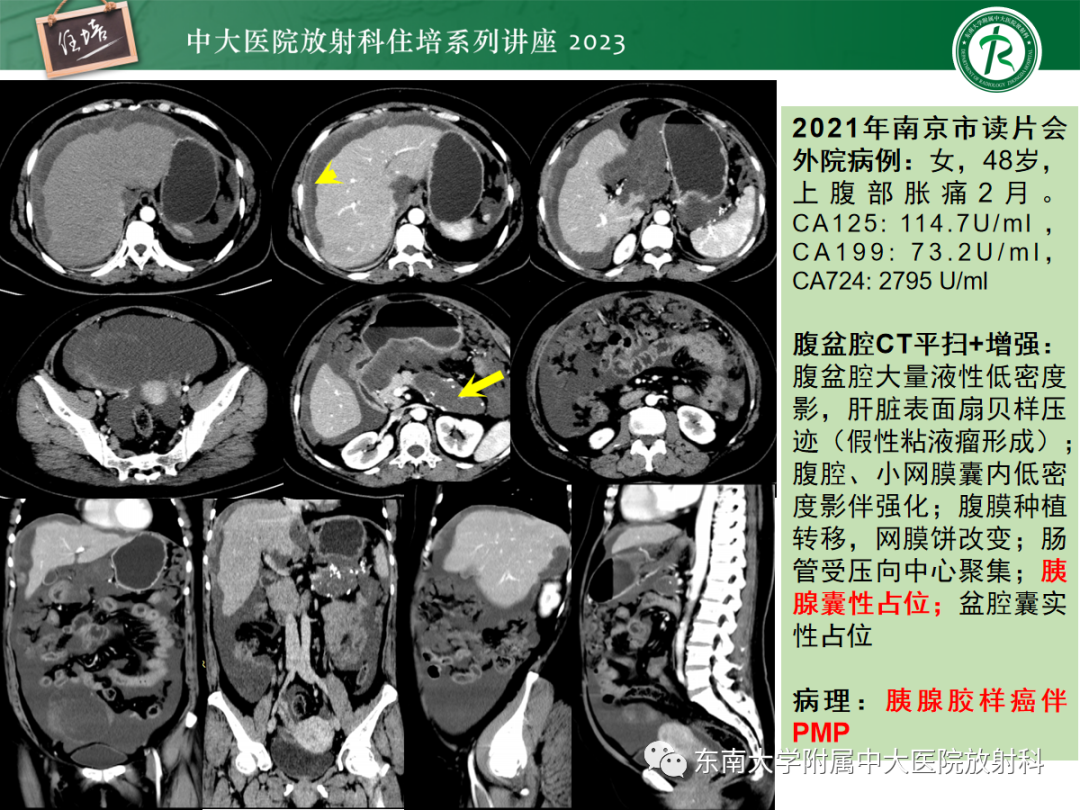 影像PPT - 【PPT】腹膜弥漫性病变-43