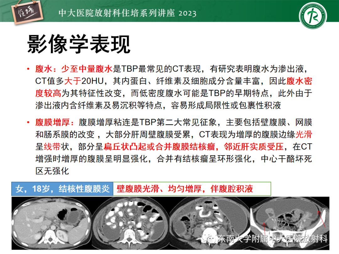 影像PPT - 【PPT】腹膜弥漫性病变-46