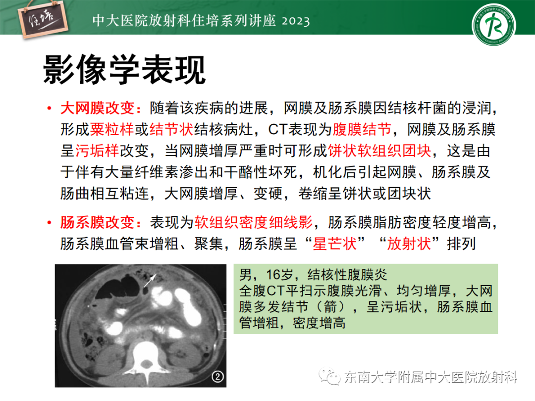 影像PPT - 【PPT】腹膜弥漫性病变-47