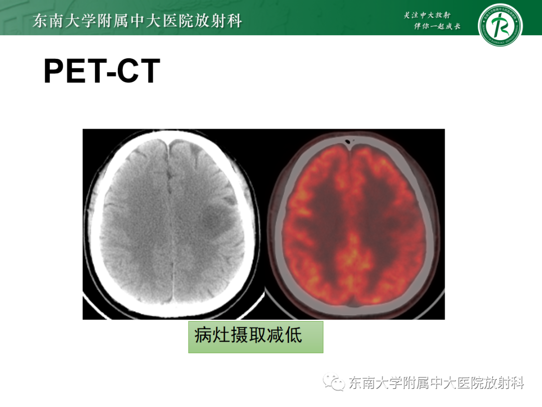 影像PPT - 【PPT】脱髓鞘假瘤-2 影像PPT - 【PPT】脱髓鞘假瘤-2