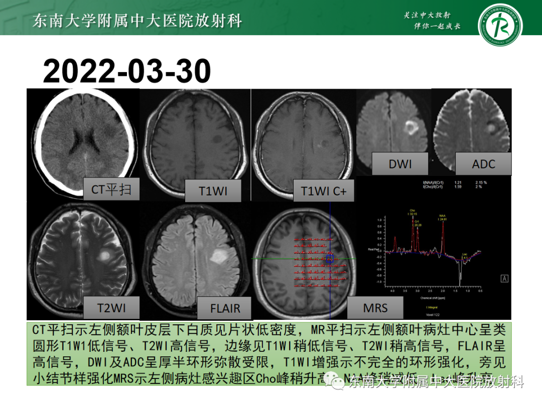 影像PPT - 【PPT】脱髓鞘假瘤-3 影像PPT - 【PPT】脱髓鞘假瘤-3