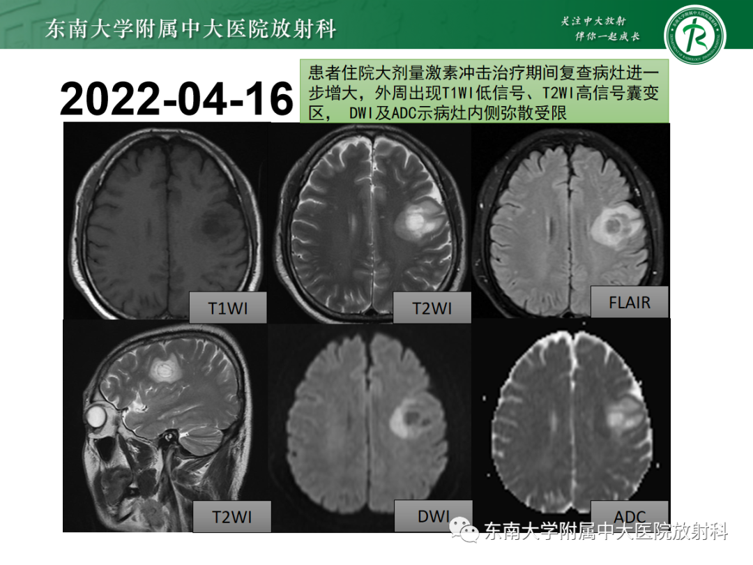 影像PPT - 【PPT】脱髓鞘假瘤-4 影像PPT - 【PPT】脱髓鞘假瘤-4
