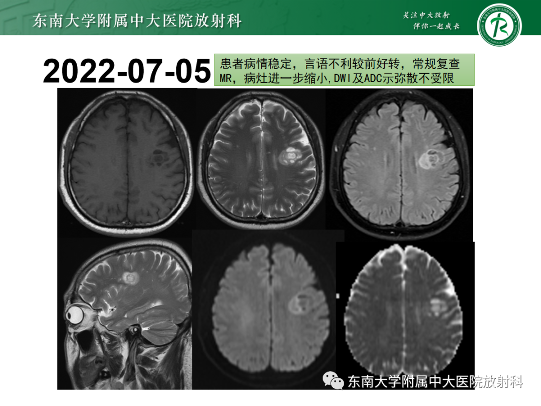 影像PPT - 【PPT】脱髓鞘假瘤-5 影像PPT - 【PPT】脱髓鞘假瘤-5