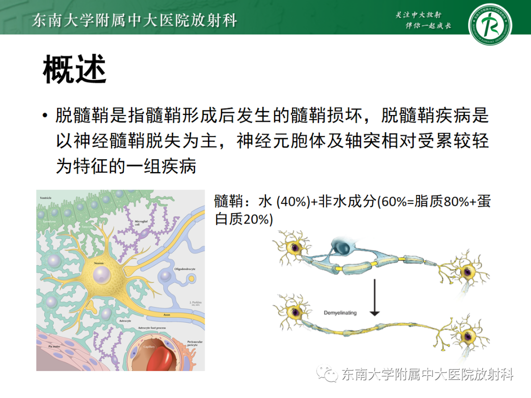 影像PPT - 【PPT】脱髓鞘假瘤-8 影像PPT - 【PPT】脱髓鞘假瘤-8