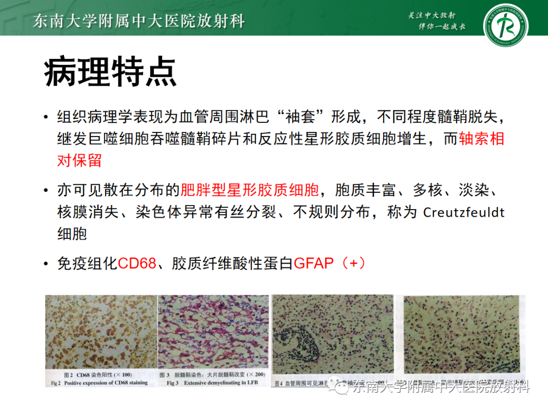 影像PPT - 【PPT】脱髓鞘假瘤-11 影像PPT - 【PPT】脱髓鞘假瘤-11