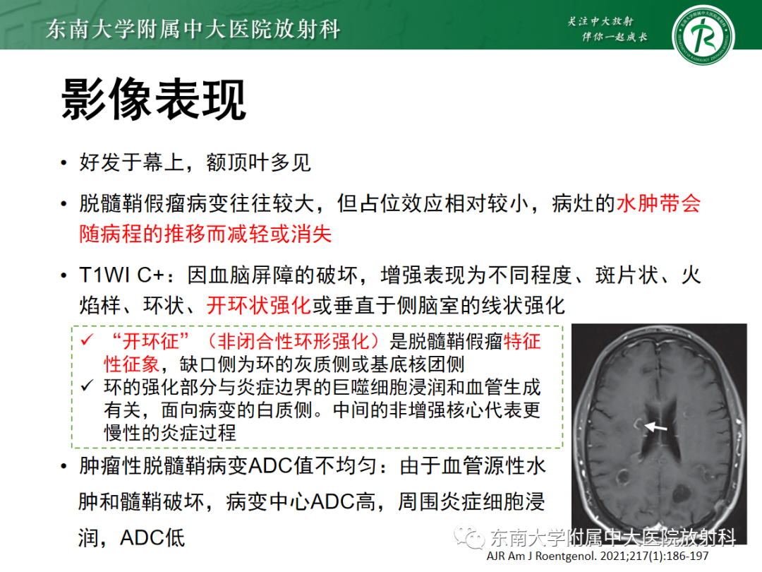 影像PPT - 【PPT】脱髓鞘假瘤-15 影像PPT - 【PPT】脱髓鞘假瘤-15