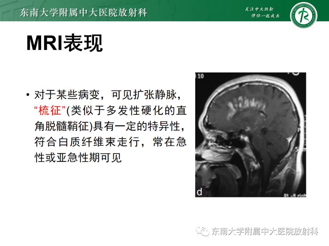影像PPT - 【PPT】脱髓鞘假瘤-16 影像PPT - 【PPT】脱髓鞘假瘤-16