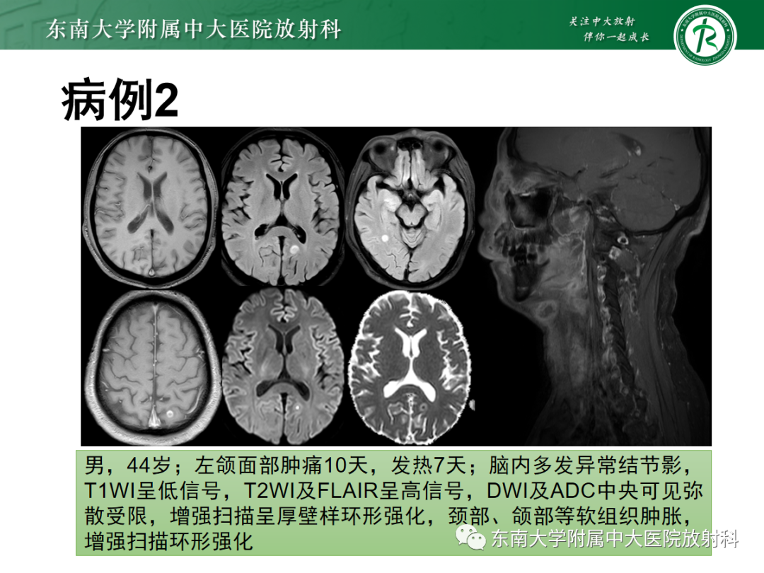 影像PPT - 【PPT】脱髓鞘假瘤-24 影像PPT - 【PPT】脱髓鞘假瘤-24