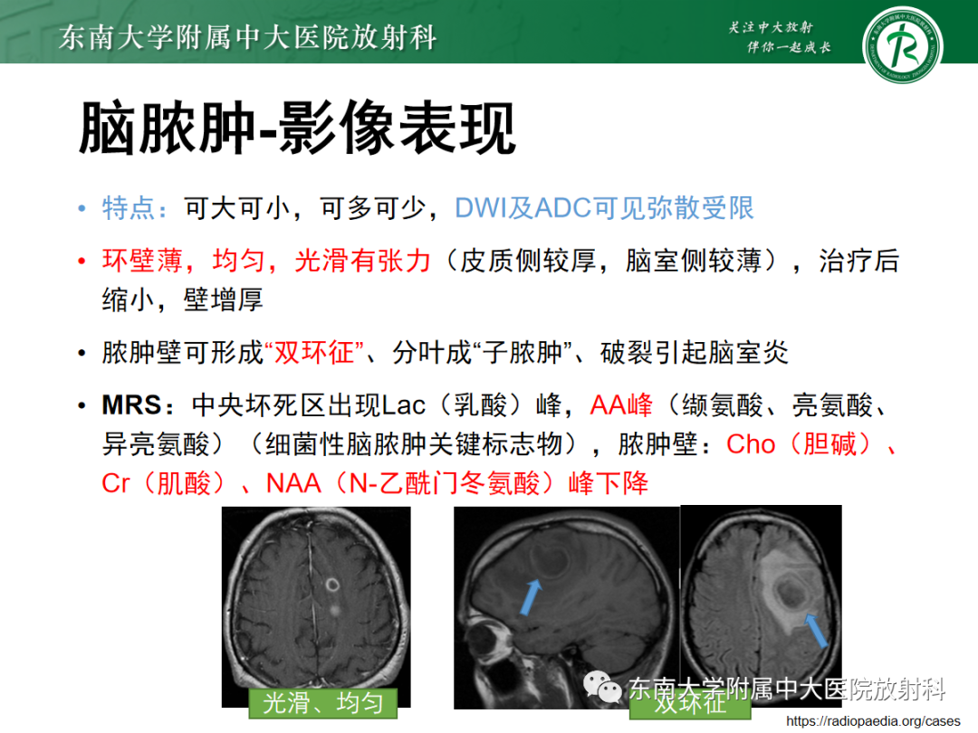 影像PPT - 【PPT】脱髓鞘假瘤-28 影像PPT - 【PPT】脱髓鞘假瘤-28