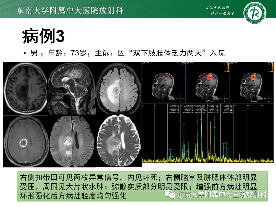 影像PPT - 【PPT】脱髓鞘假瘤-29 影像PPT - 【PPT】脱髓鞘假瘤-29