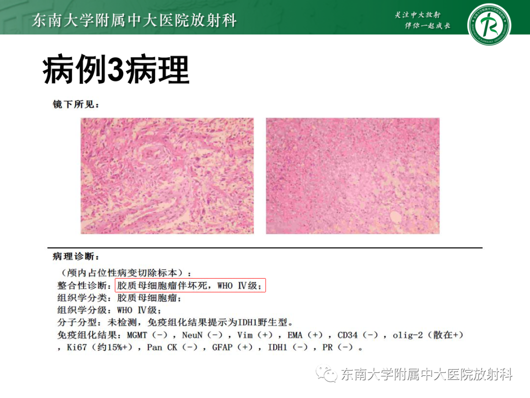 影像PPT - 【PPT】脱髓鞘假瘤-30 影像PPT - 【PPT】脱髓鞘假瘤-30