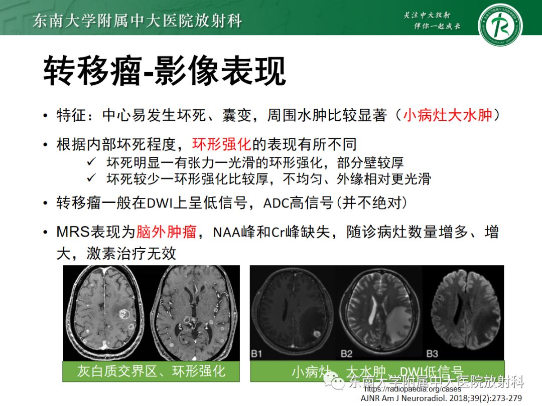 影像PPT - 【PPT】脱髓鞘假瘤-34 影像PPT - 【PPT】脱髓鞘假瘤-34