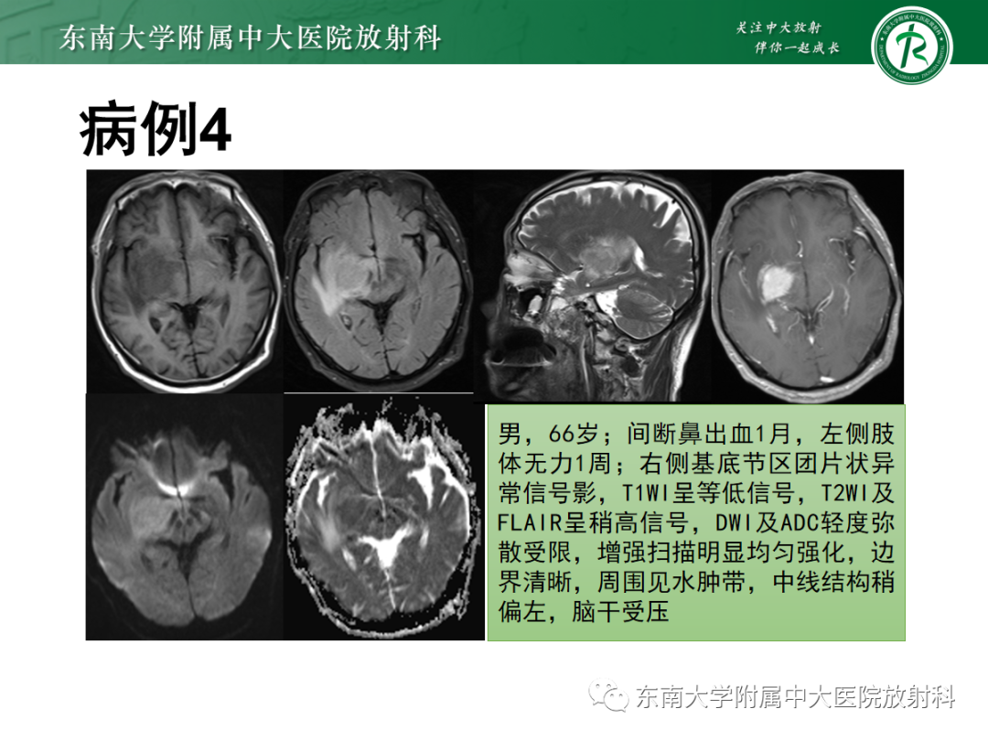 影像PPT - 【PPT】脱髓鞘假瘤-35 影像PPT - 【PPT】脱髓鞘假瘤-35