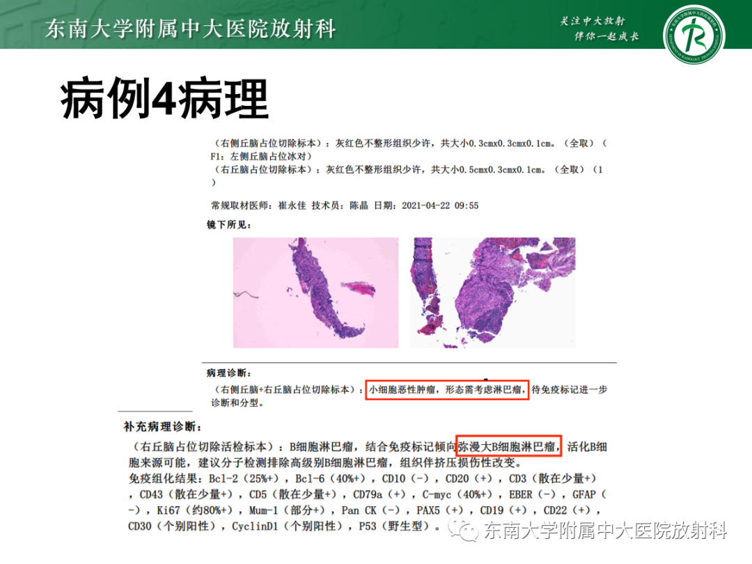 影像PPT - 【PPT】脱髓鞘假瘤-36 影像PPT - 【PPT】脱髓鞘假瘤-36