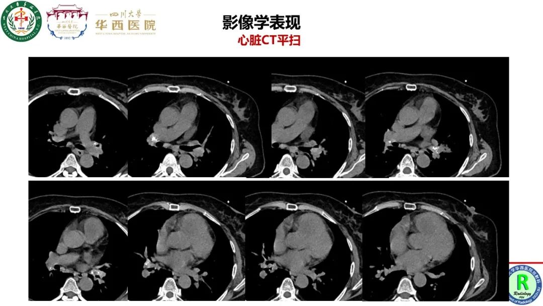 影像PPT - 【病例】心脏粘液瘤1例CT影像-4
