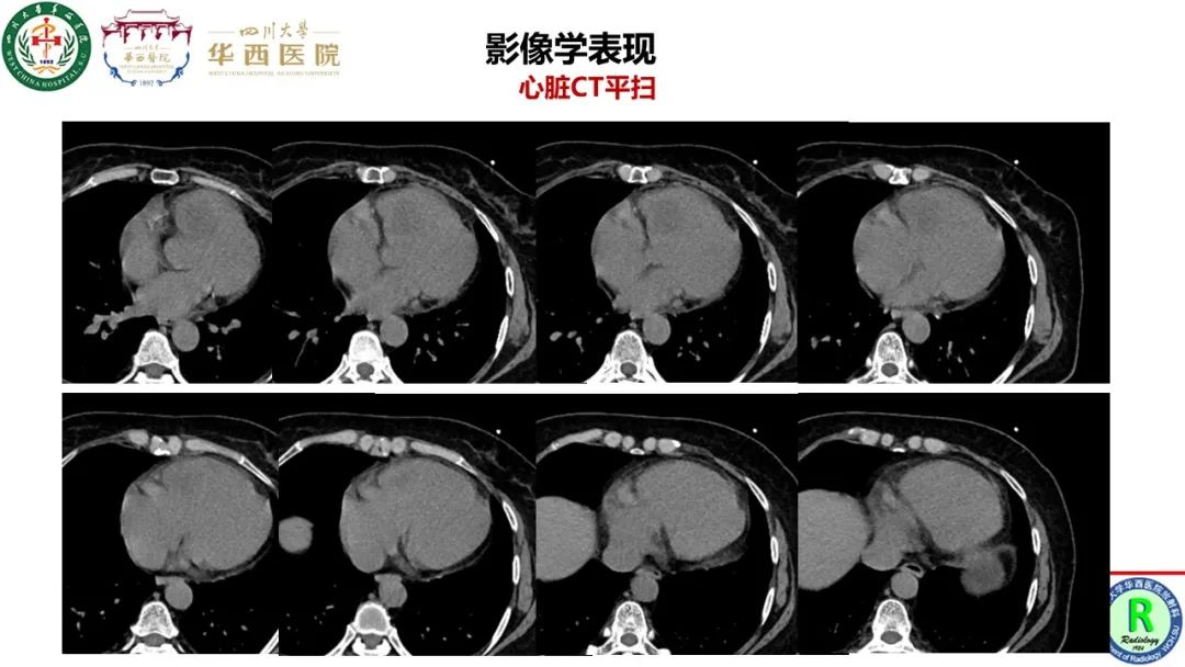 影像PPT - 【病例】心脏粘液瘤1例CT影像-5