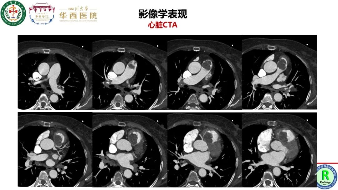 影像PPT - 【病例】心脏粘液瘤1例CT影像-6