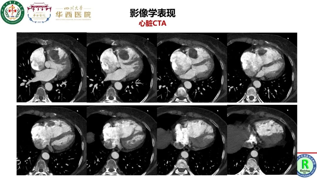 影像PPT - 【病例】心脏粘液瘤1例CT影像-7