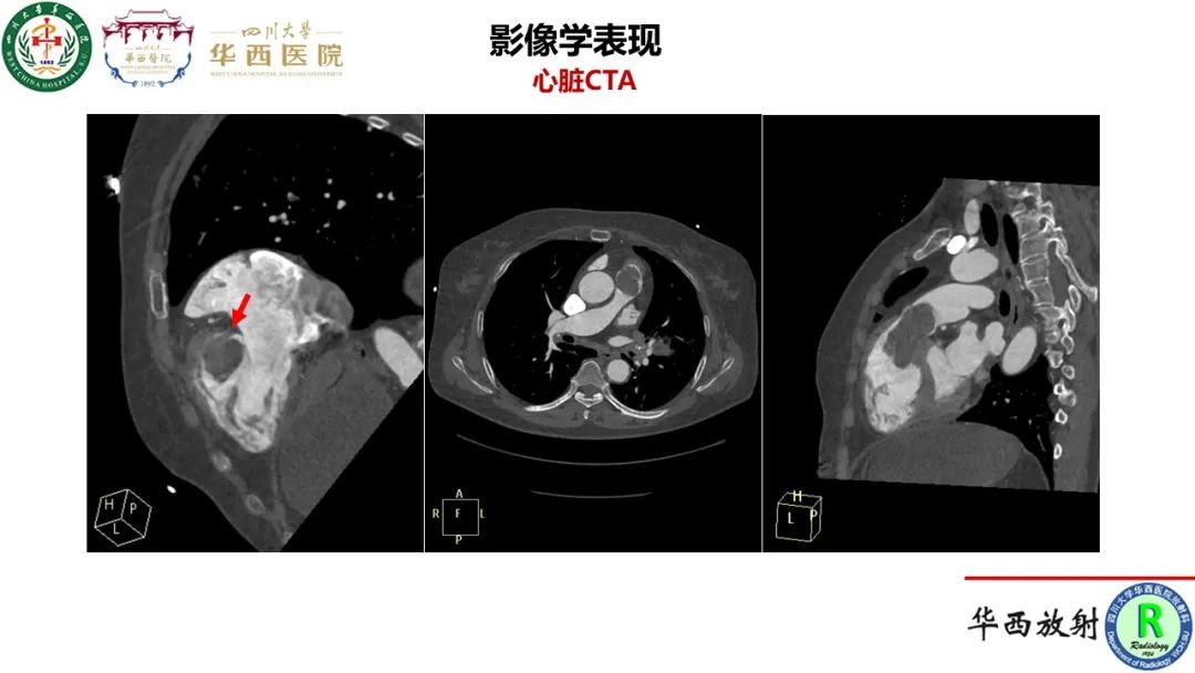 影像PPT - 【病例】心脏粘液瘤1例CT影像-8