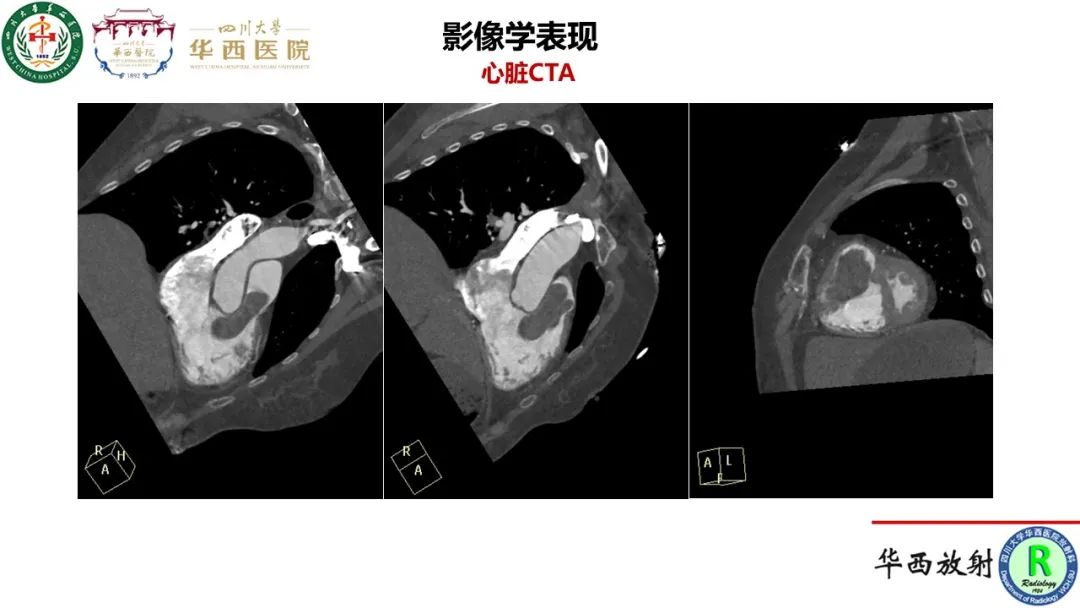 影像PPT - 【病例】心脏粘液瘤1例CT影像-9
