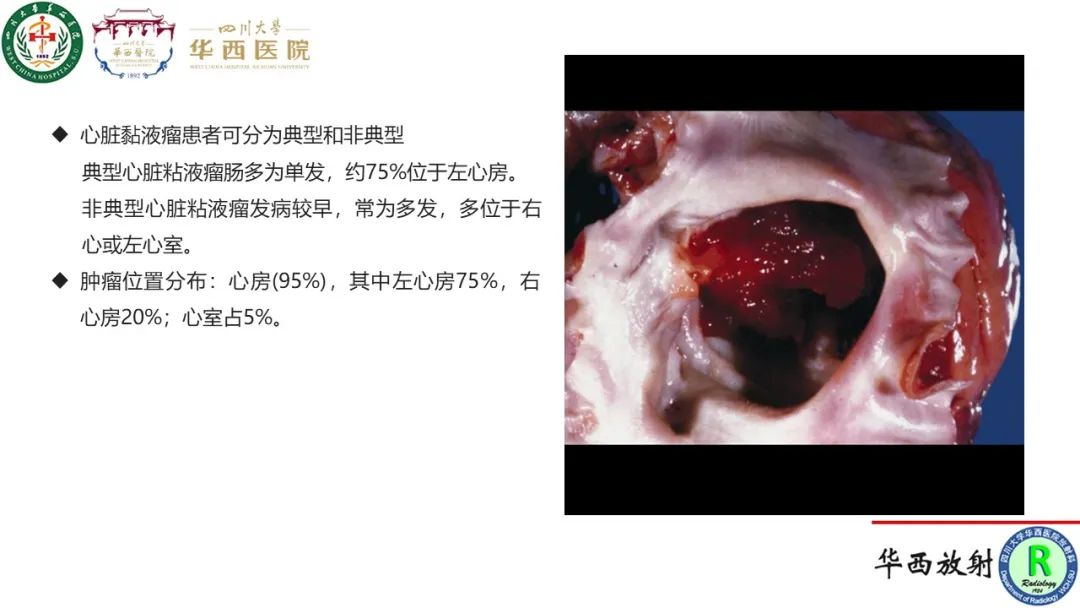影像PPT - 【病例】心脏粘液瘤1例CT影像-15
