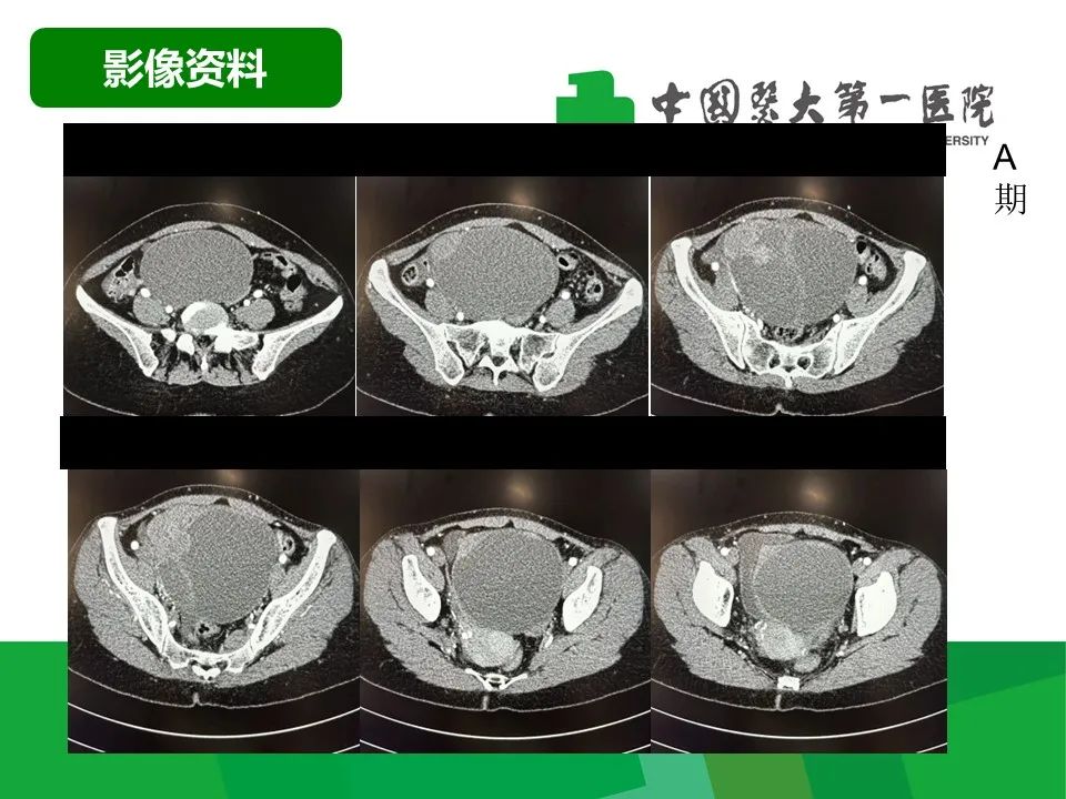 影像PPT - 【病例】卵巢Brenner瘤1例CT影像-4
