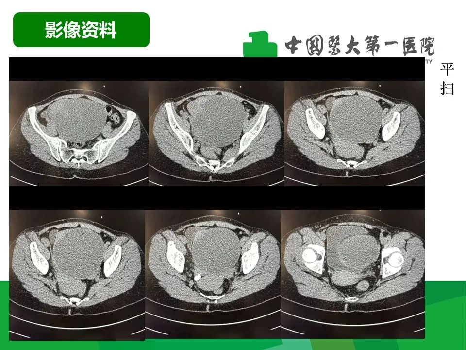 影像PPT - 【病例】卵巢Brenner瘤1例CT影像-3