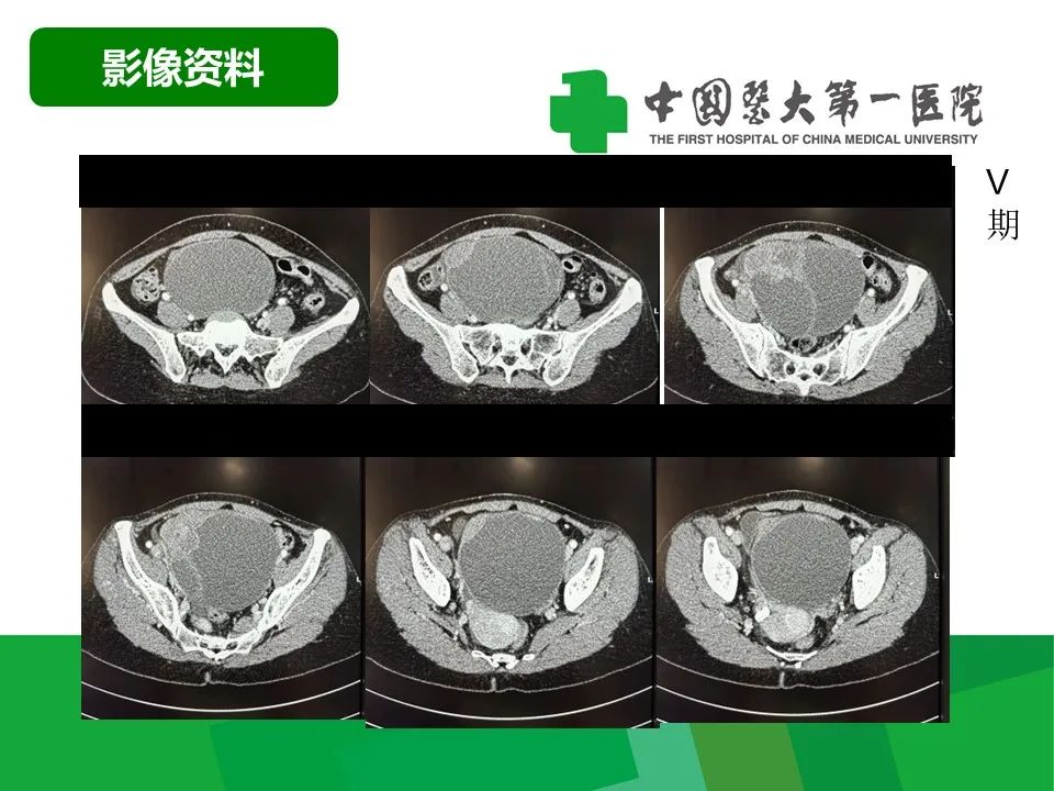 影像PPT - 【病例】卵巢Brenner瘤1例CT影像-5
