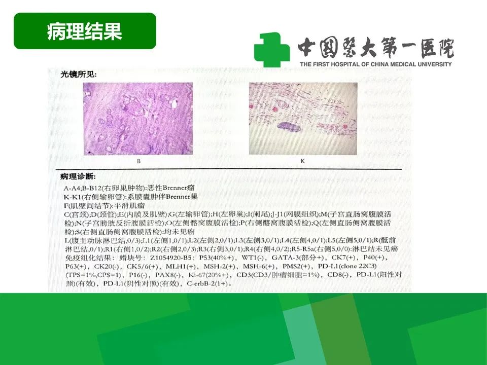 影像PPT - 【病例】卵巢Brenner瘤1例CT影像-7