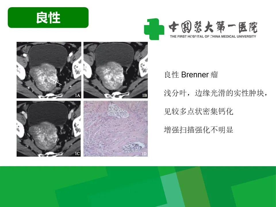 影像PPT - 【病例】卵巢Brenner瘤1例CT影像-12