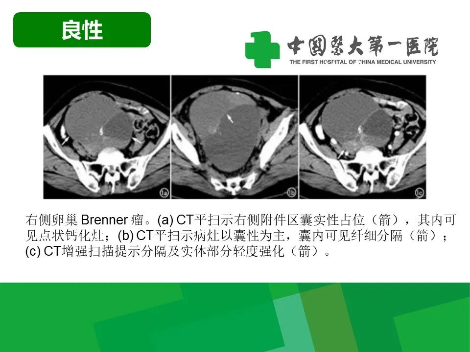 影像PPT - 【病例】卵巢Brenner瘤1例CT影像-14