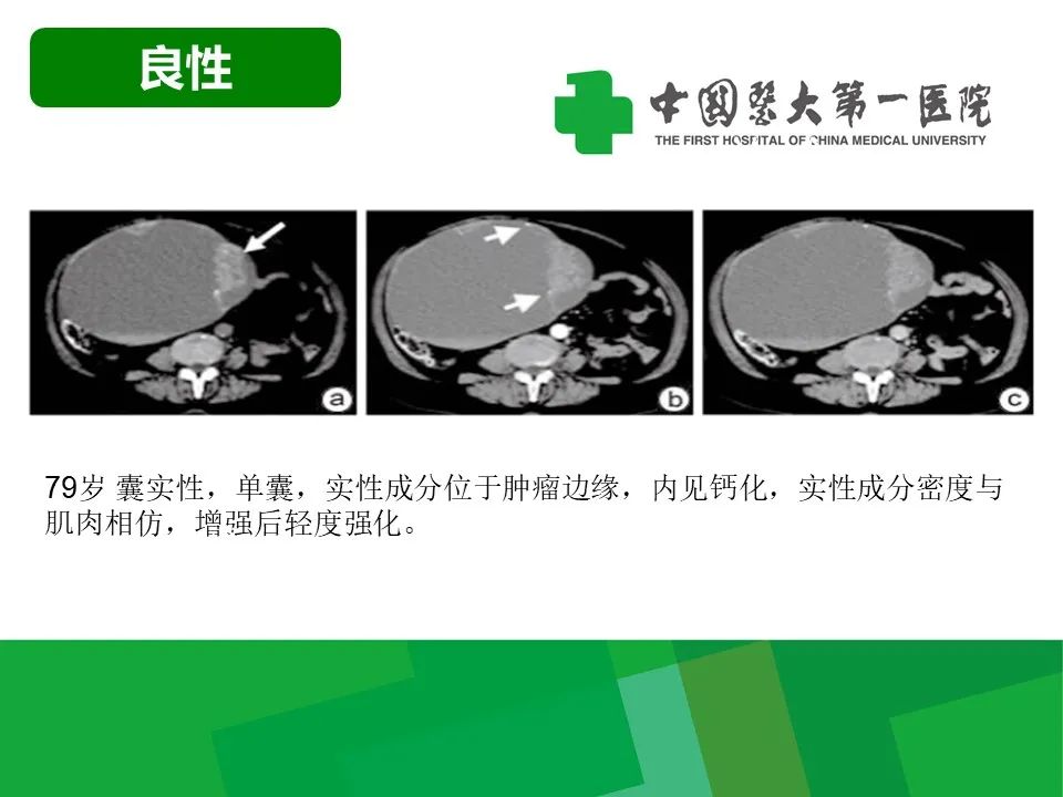影像PPT - 【病例】卵巢Brenner瘤1例CT影像-13