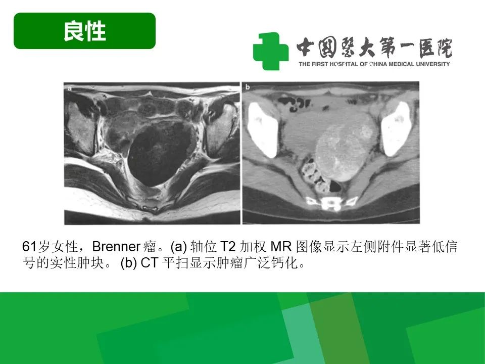 影像PPT - 【病例】卵巢Brenner瘤1例CT影像-15