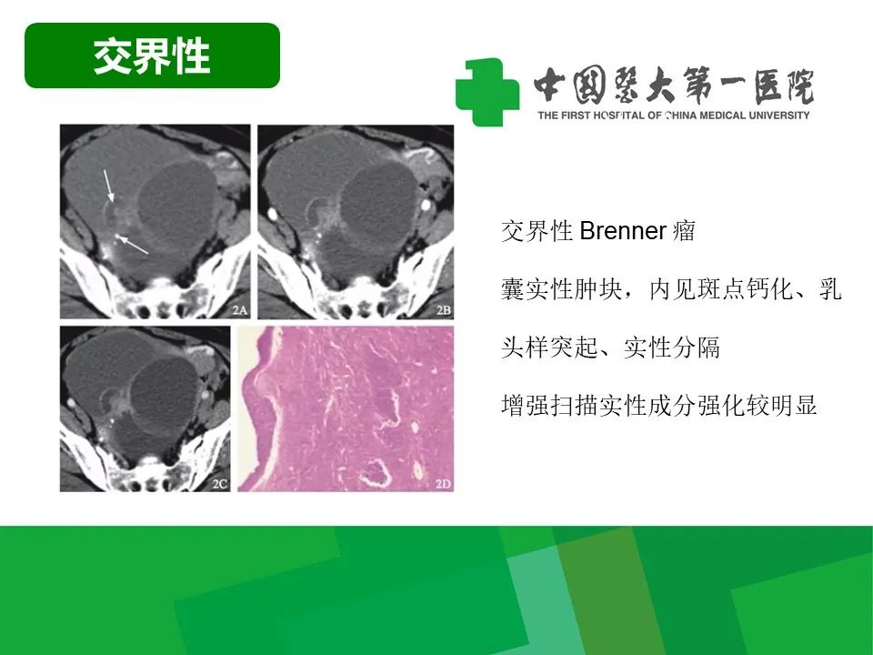 影像PPT - 【病例】卵巢Brenner瘤1例CT影像-16