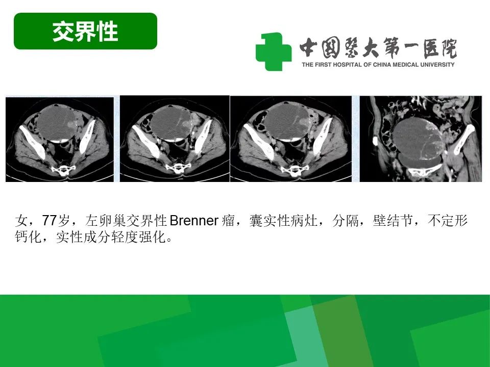影像PPT - 【病例】卵巢Brenner瘤1例CT影像-17