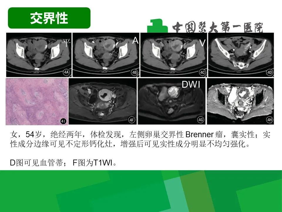 影像PPT - 【病例】卵巢Brenner瘤1例CT影像-18