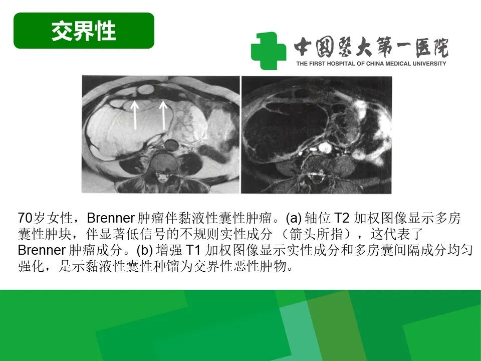 影像PPT - 【病例】卵巢Brenner瘤1例CT影像-19