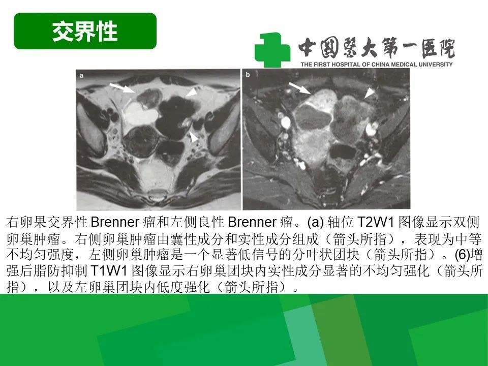 影像PPT - 【病例】卵巢Brenner瘤1例CT影像-20