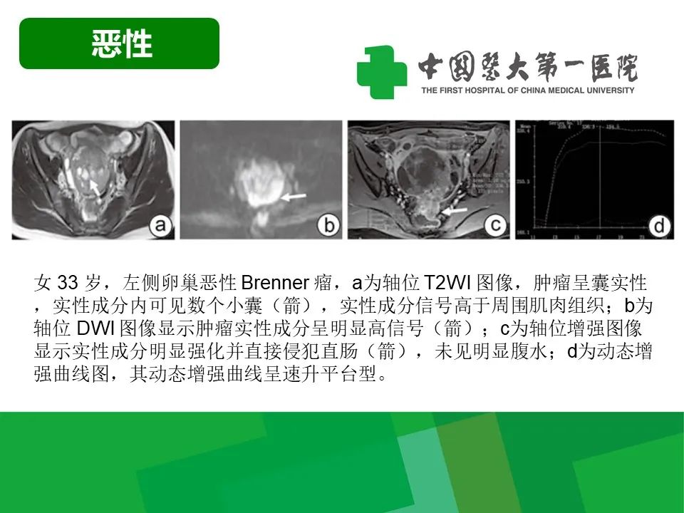 影像PPT - 【病例】卵巢Brenner瘤1例CT影像-21