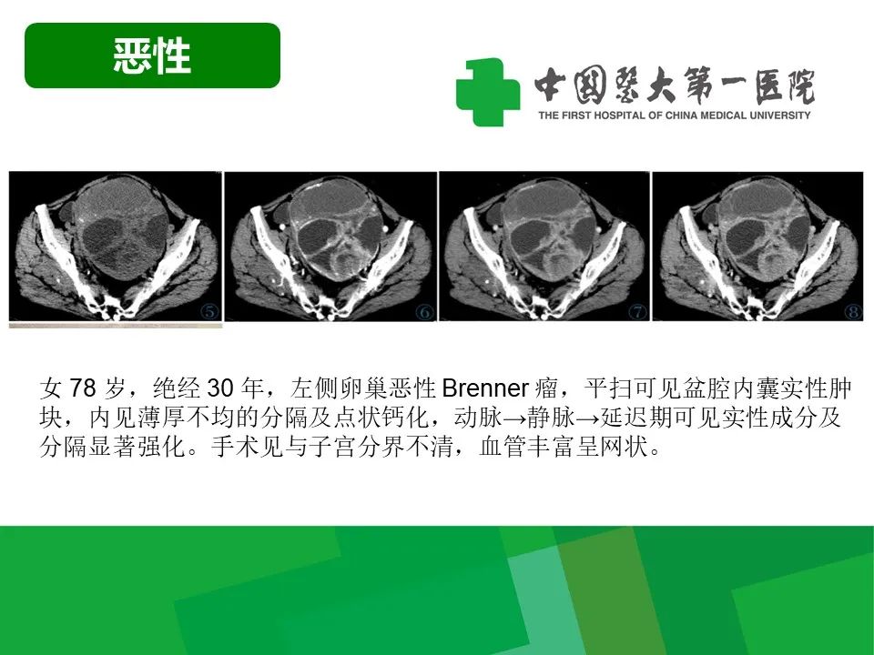影像PPT - 【病例】卵巢Brenner瘤1例CT影像-22