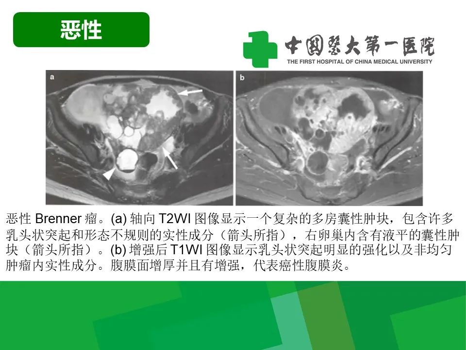 影像PPT - 【病例】卵巢Brenner瘤1例CT影像-23