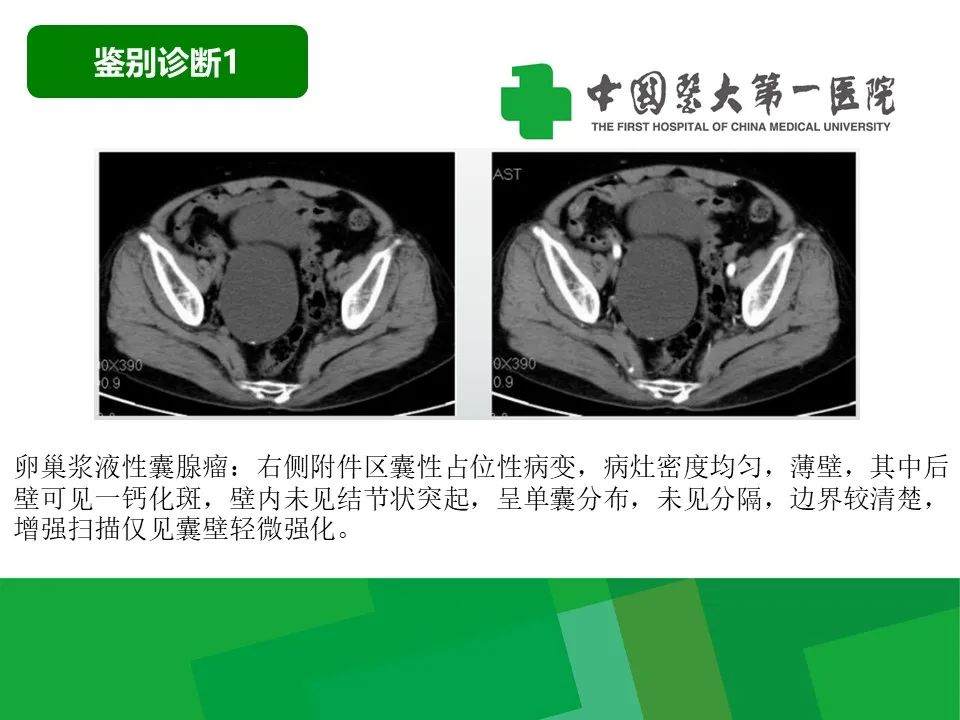 影像PPT - 【病例】卵巢Brenner瘤1例CT影像-27