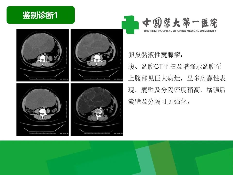 影像PPT - 【病例】卵巢Brenner瘤1例CT影像-28