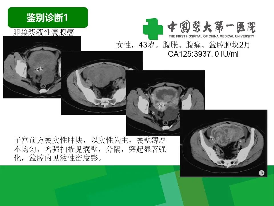 影像PPT - 【病例】卵巢Brenner瘤1例CT影像-30