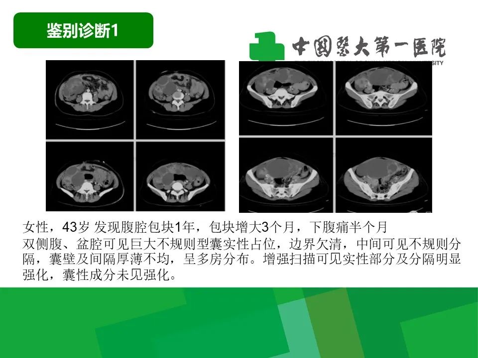 影像PPT - 【病例】卵巢Brenner瘤1例CT影像-31