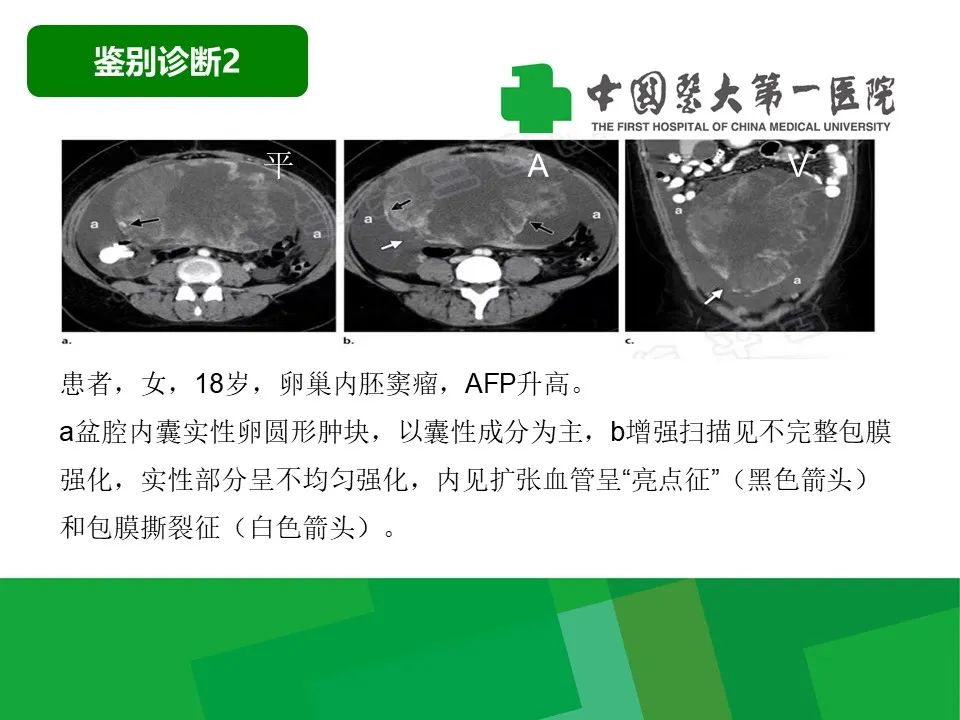 影像PPT - 【病例】卵巢Brenner瘤1例CT影像-33