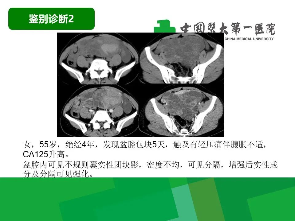 影像PPT - 【病例】卵巢Brenner瘤1例CT影像-36