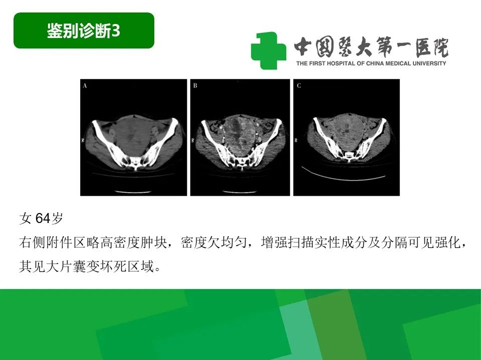 影像PPT - 【病例】卵巢Brenner瘤1例CT影像-37